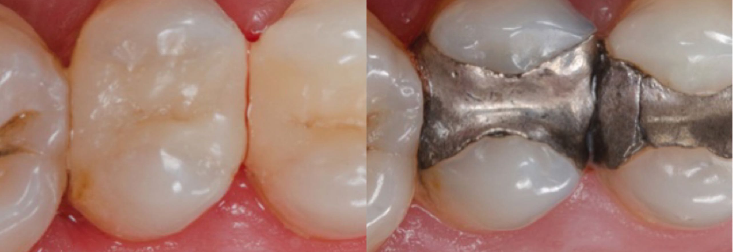 上颌前臼齿嵌体修复与永久冠树脂的关系